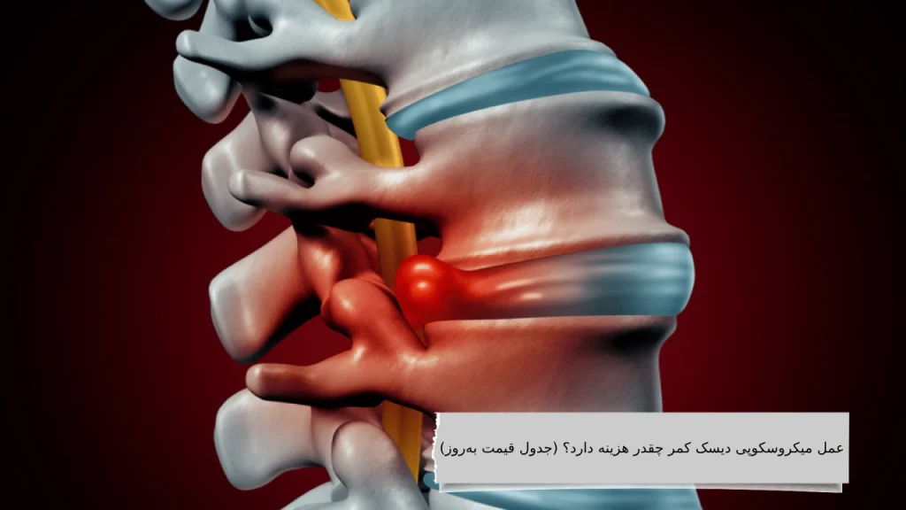 هزینه عمل میکروسکوپی دیسک کمر