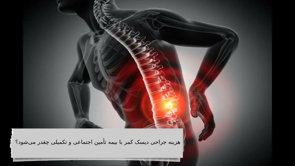هزینه عمل میکروسکوپی دیسک کمر