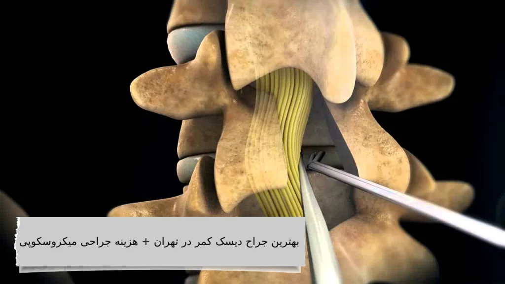 هزینه عمل میکروسکوپی دیسک کمر
